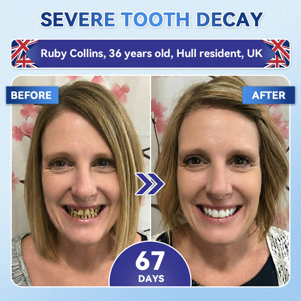 KLENIMORE® 🦷 Tideglusib Fast‑Dissolving Tooth & Gum Repair Oral Strips 💥🎉 (Supports tooth repair and helps relieve gum discomfort and other common oral concerns)